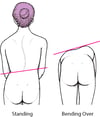 Scoliosis: A Curved Spine