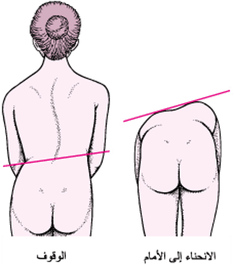 الجنف: انحناء العمود الفقري