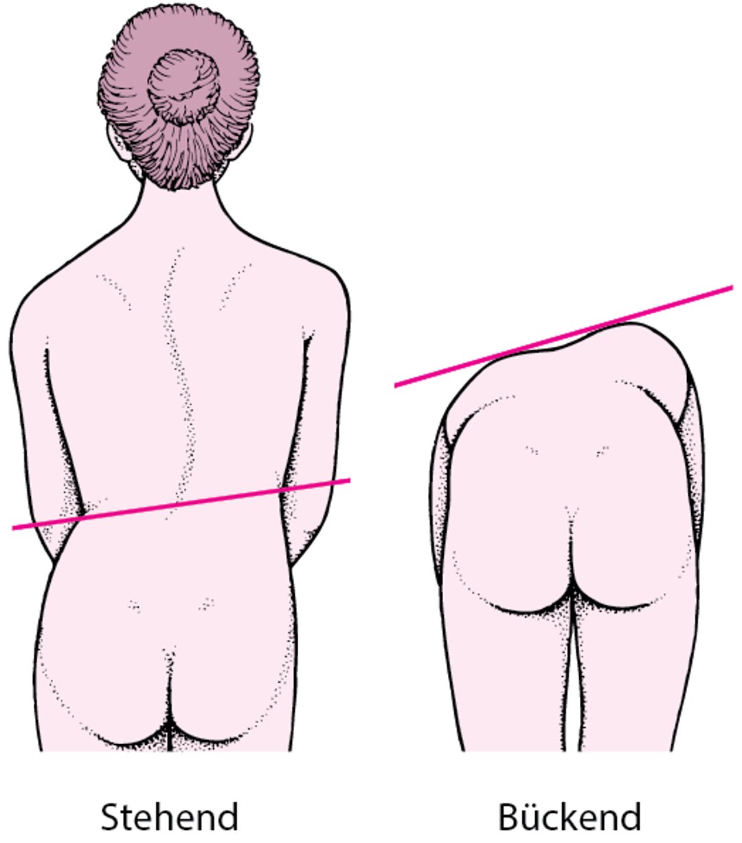 Skoliose: Verbiegung der Wirbelsäule
