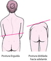 Escoliosis: una columna vertebral curvada