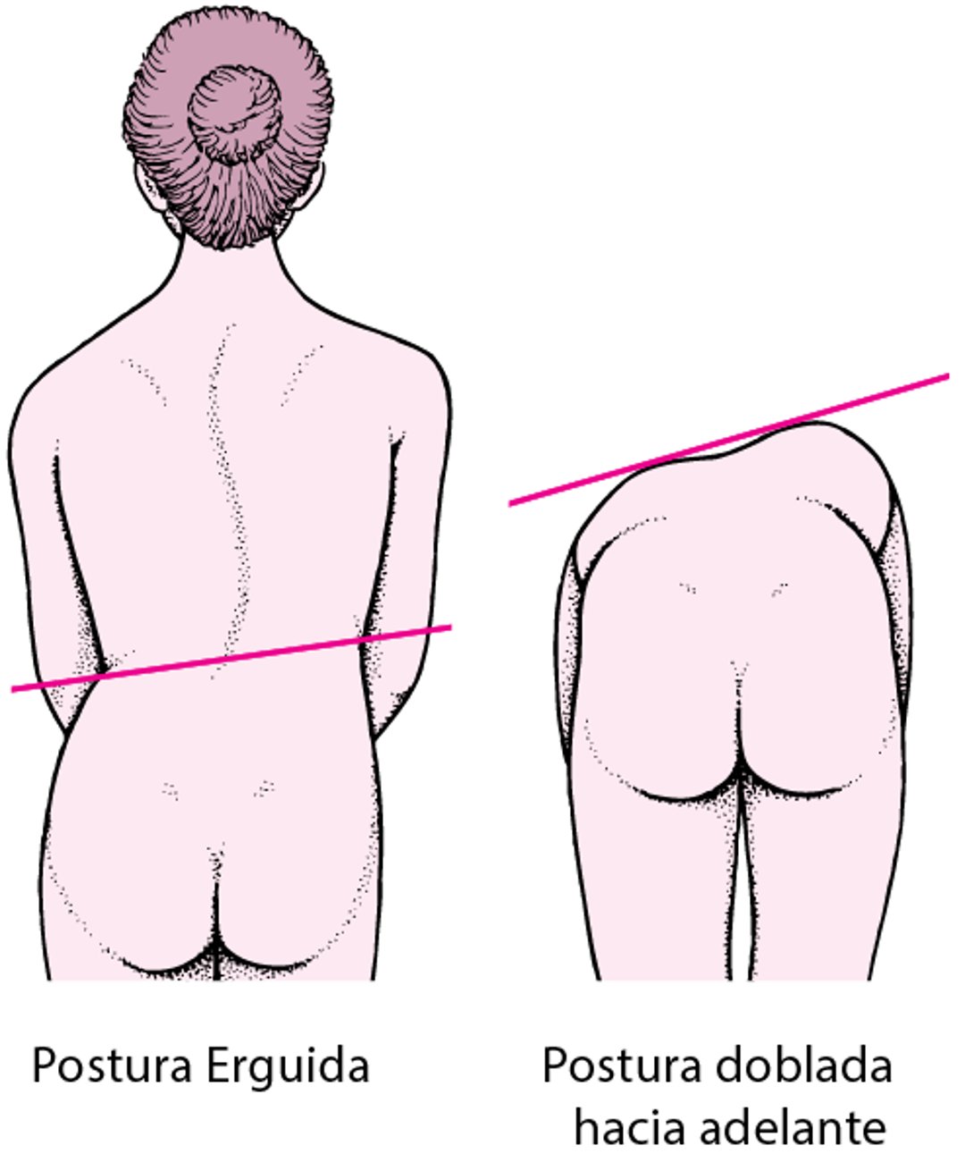 Escoliosis: una columna vertebral curvada