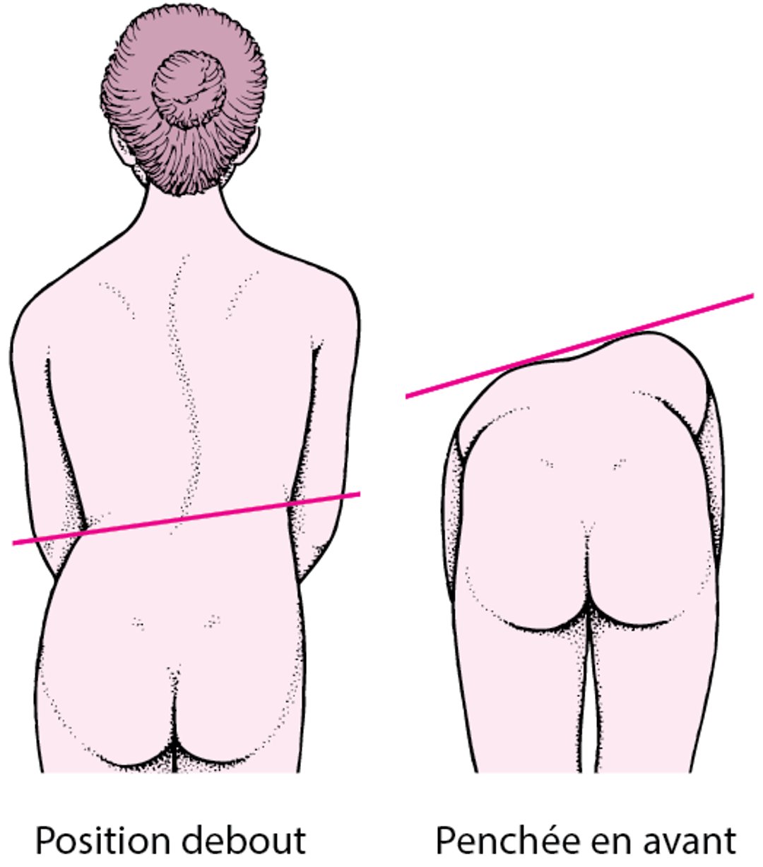 Scoliose : Une colonne vertébrale courbée