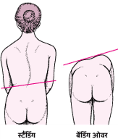 स्कोलियोसिस: एक मुड़ी हुई रीढ़