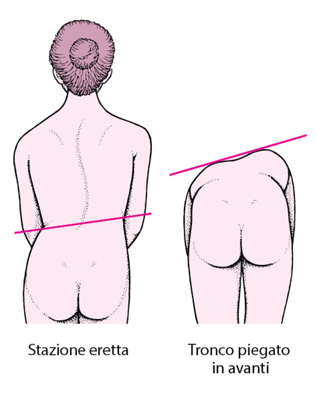 Scoliosi: Schiena deviata