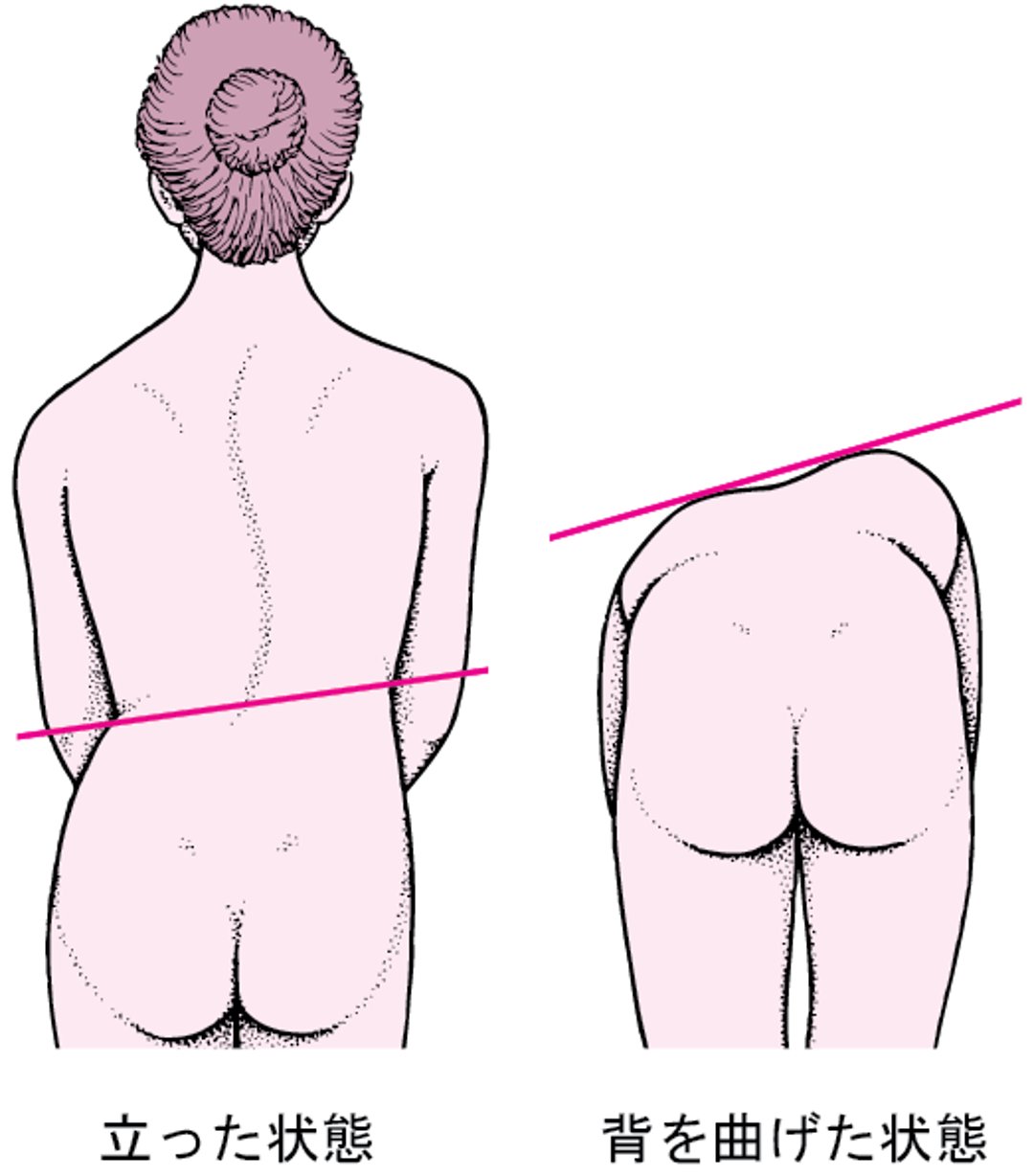 脊柱側弯症：脊柱の弯曲