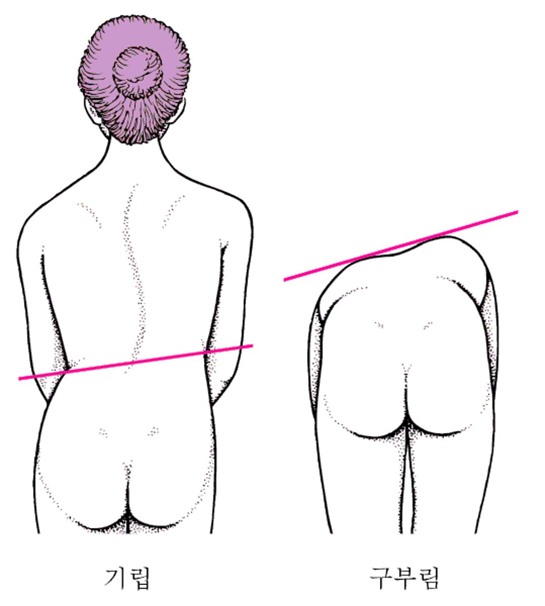 척추측만증: 굽은 척추