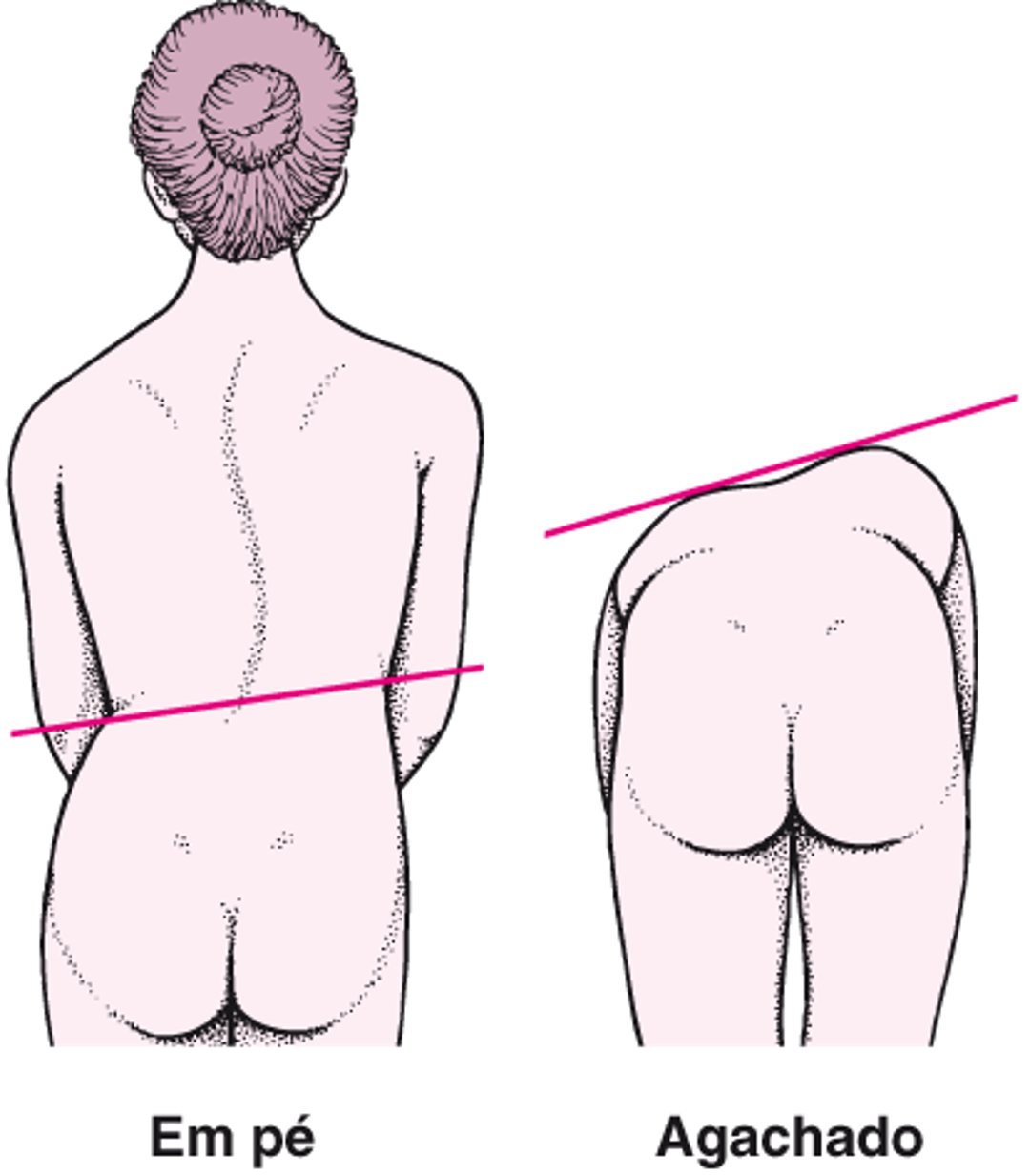 Escoliose: uma coluna vertebral encurvada