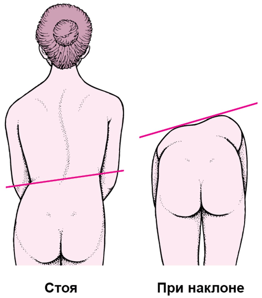Сколиоз: искривление позвоночника