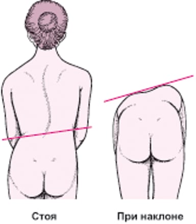 Сколиоз: искривление позвоночника