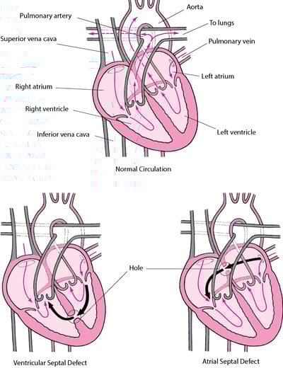 Septal Defect: A Hole in the Heart's Wall