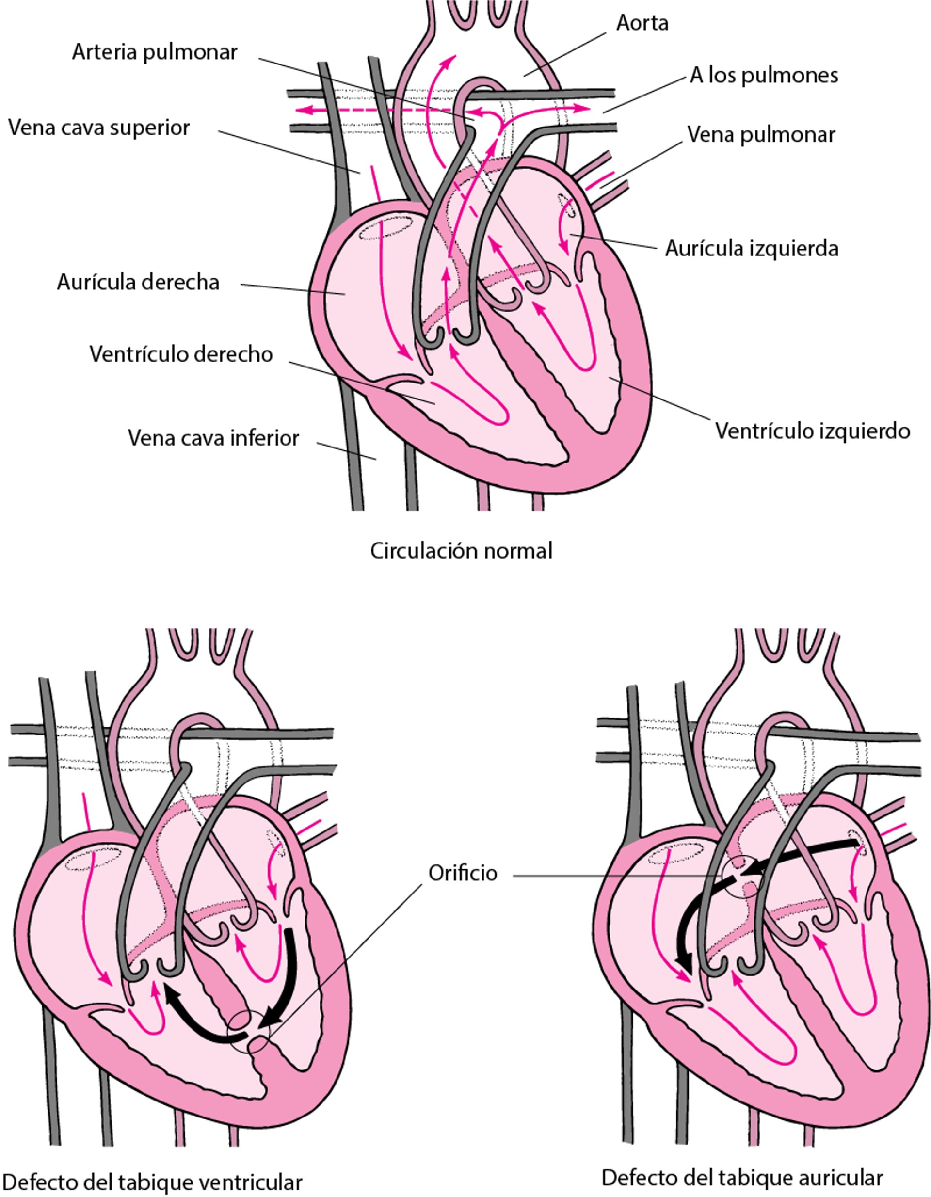 Defecto septal: orificio en la pared del corazón