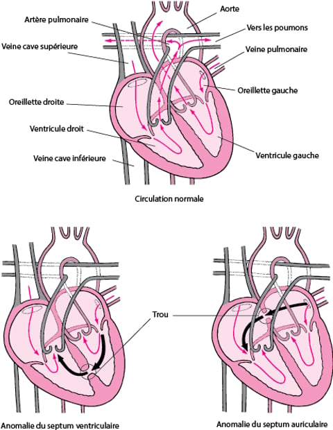 Septale Image:Communication septale : une ouverture dans le cœur-Manuels MSD ...