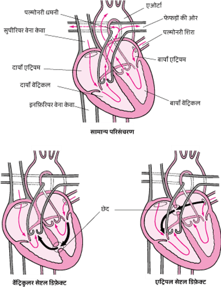 सेप्टल डिफ़ेक्ट्स: दिल की सतह में छेद