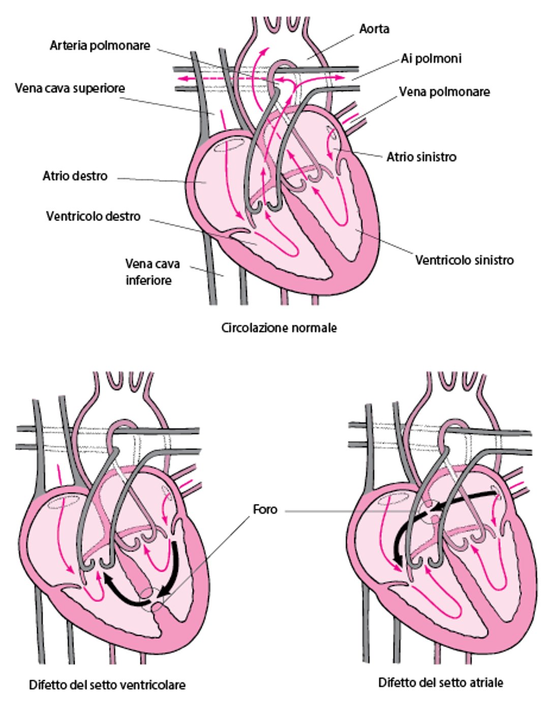 Difetto settale: foro nella parete del cuore