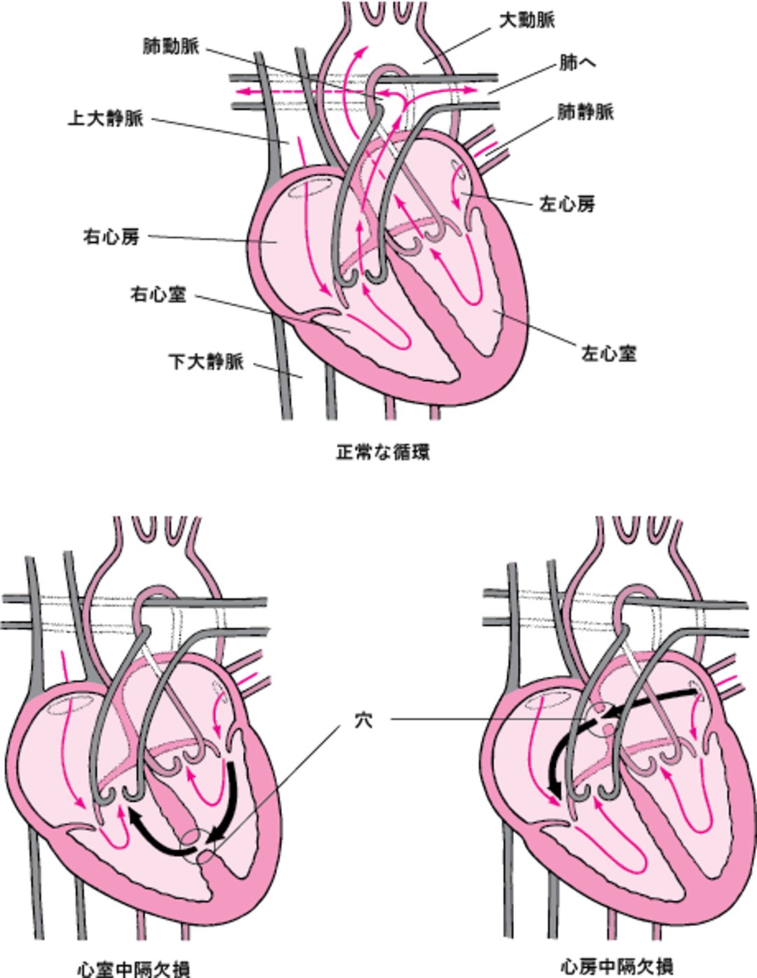 中隔欠損症ちゅうかくけっそんしょう：心臓しんぞうの壁かべの孔あな