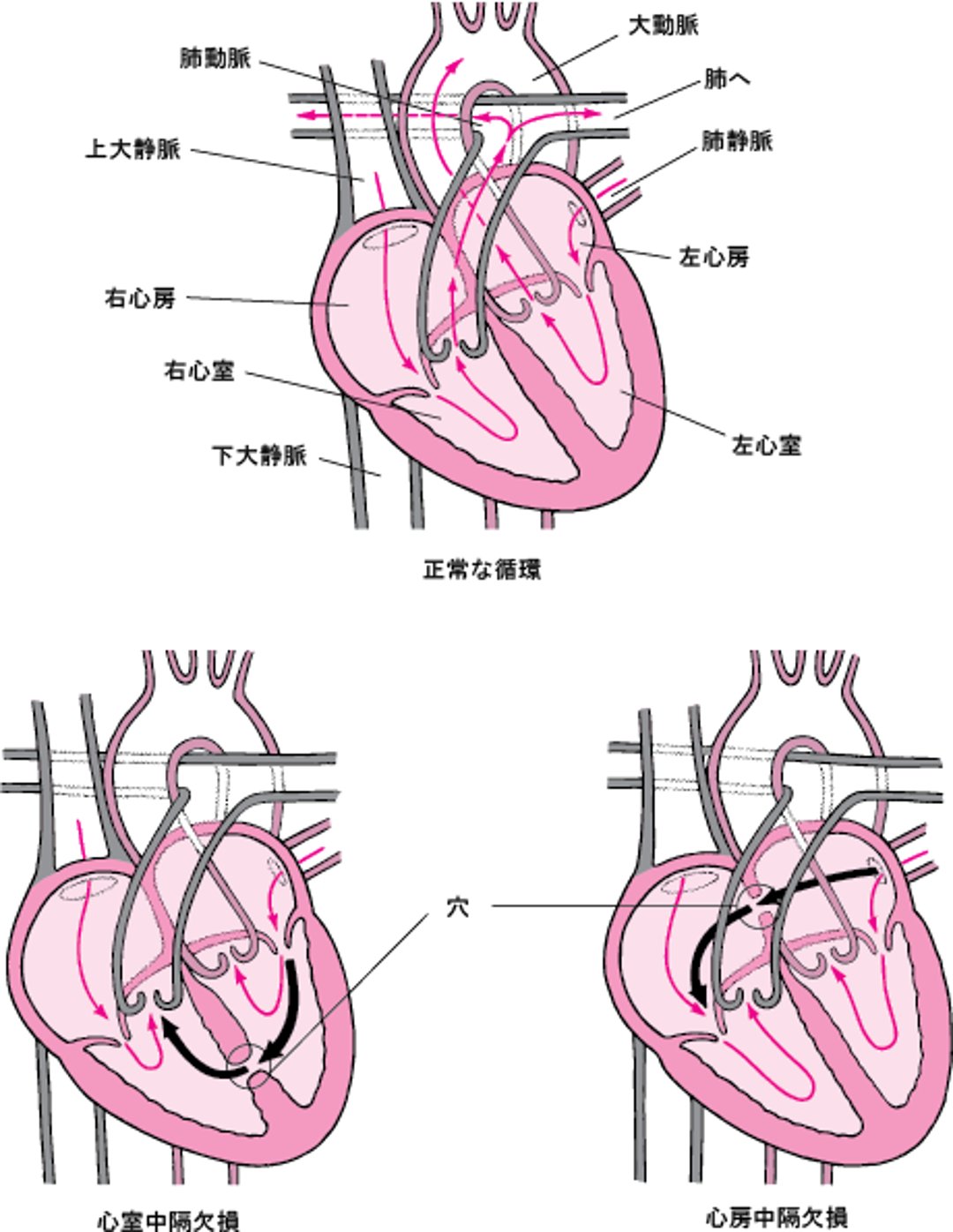 中隔欠損症：心臓の壁の孔
