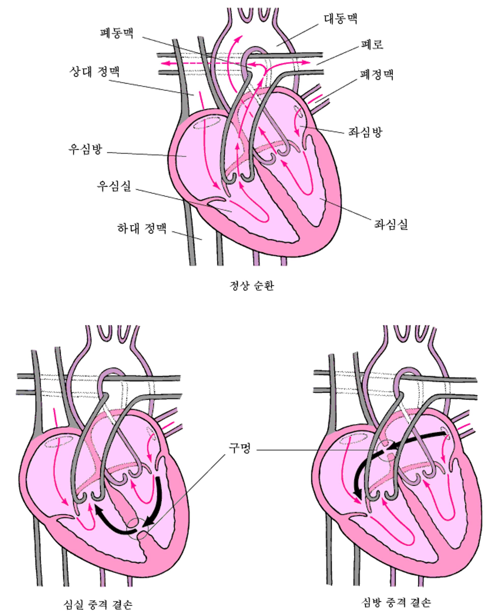 중격 결손: 심장의 벽에 있는 구멍