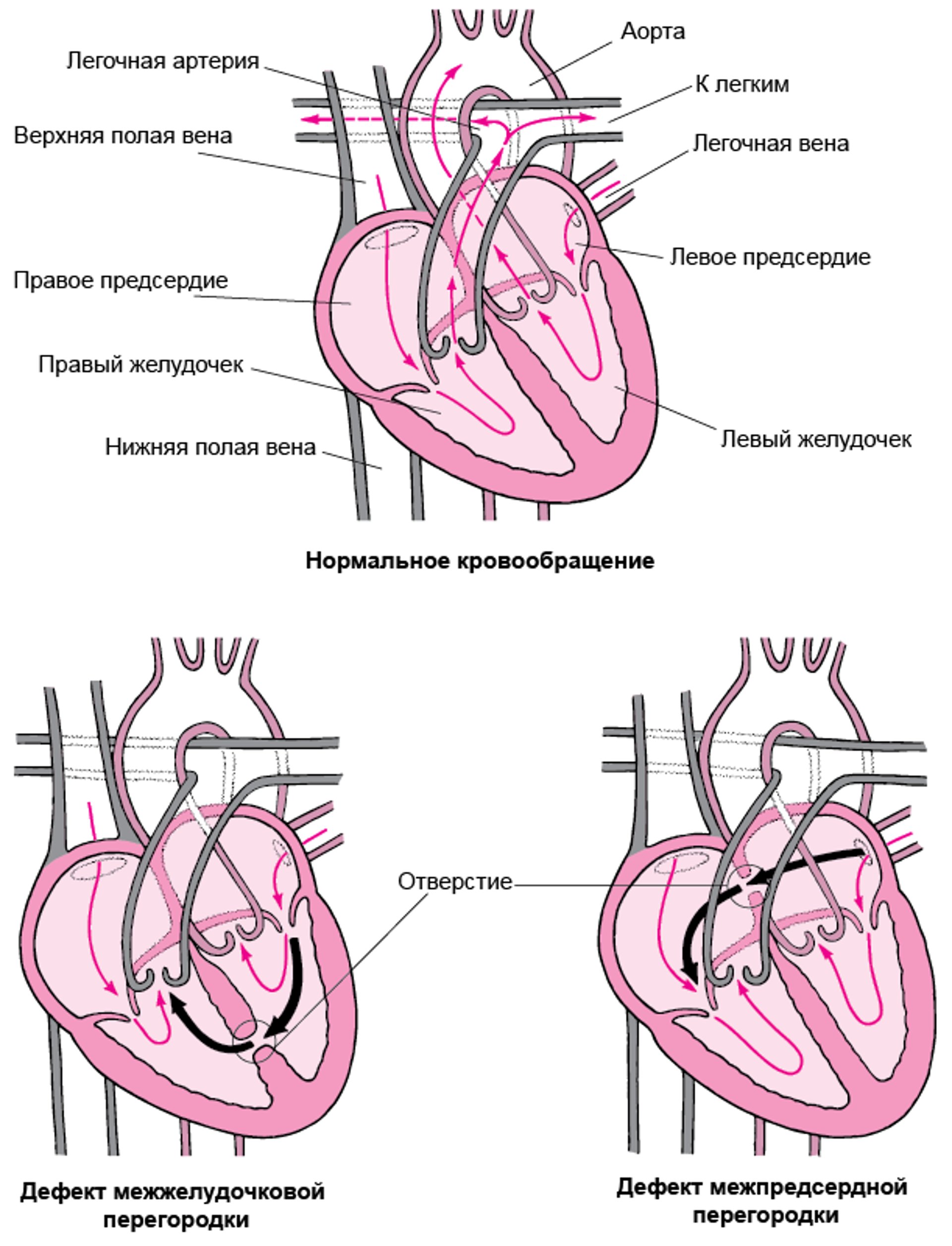 Дефект перегородки: Отверстие в стенке сердца