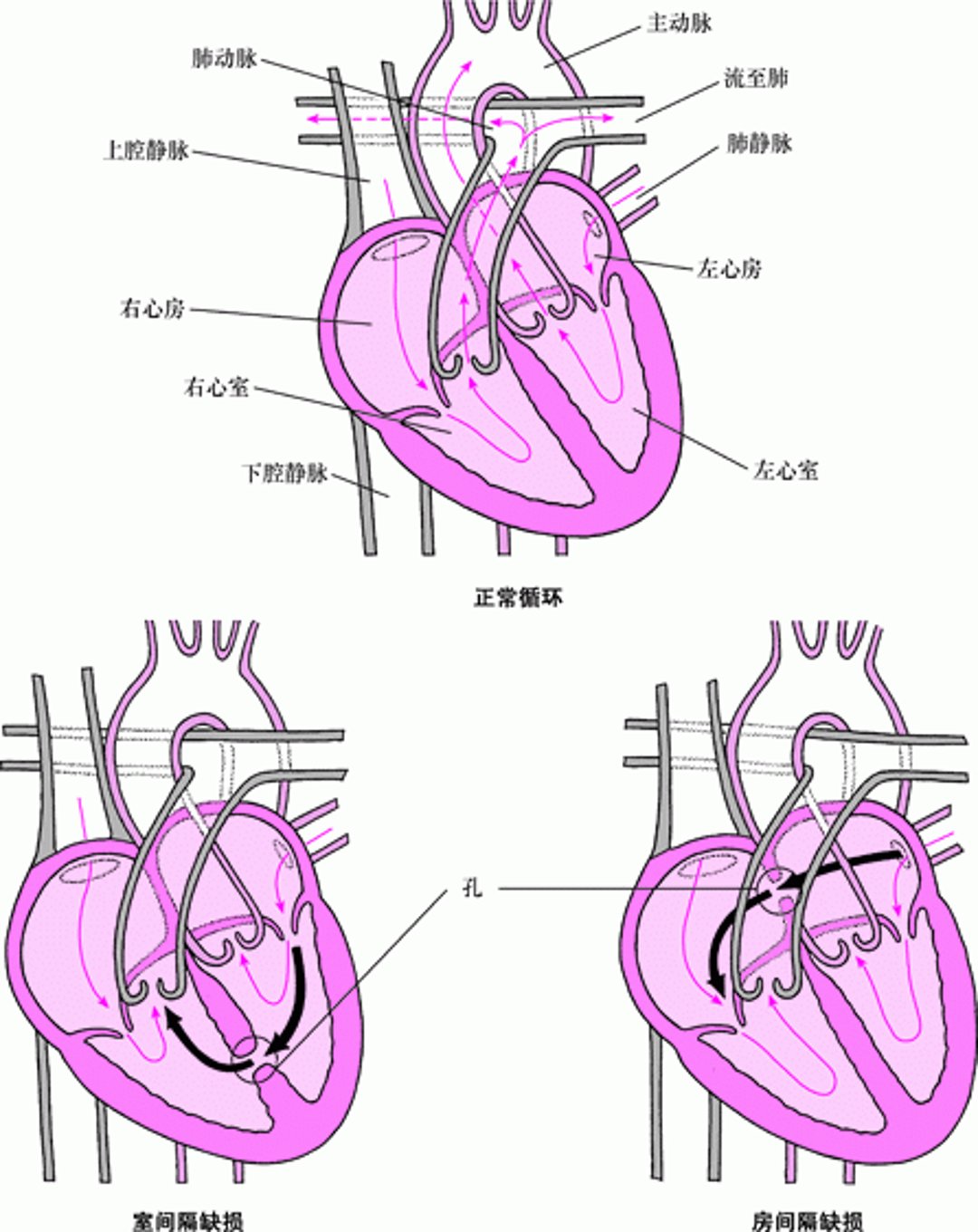 间隔缺损：心脏间隔上的缺口