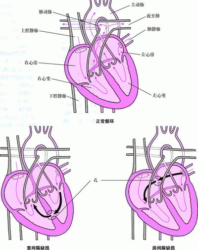 间隔缺损：心脏间隔上的缺口