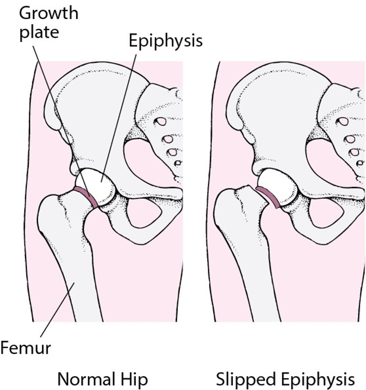 Slipped Capital Femoral Epiphysis