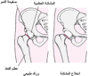 انزلاقُ مشاش رأس الفخذ Slipped Capital Femoral Epiphysis