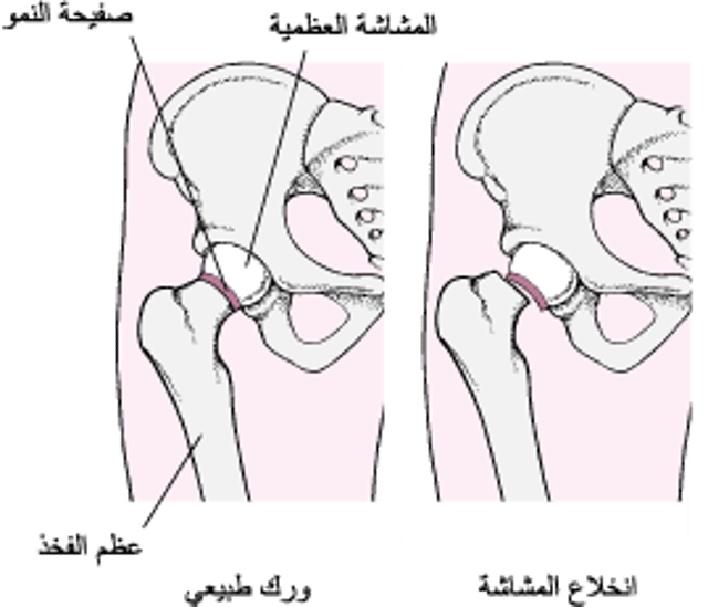 انزلاقُ مشاش رأس الفخذ Slipped Capital Femoral Epiphysis