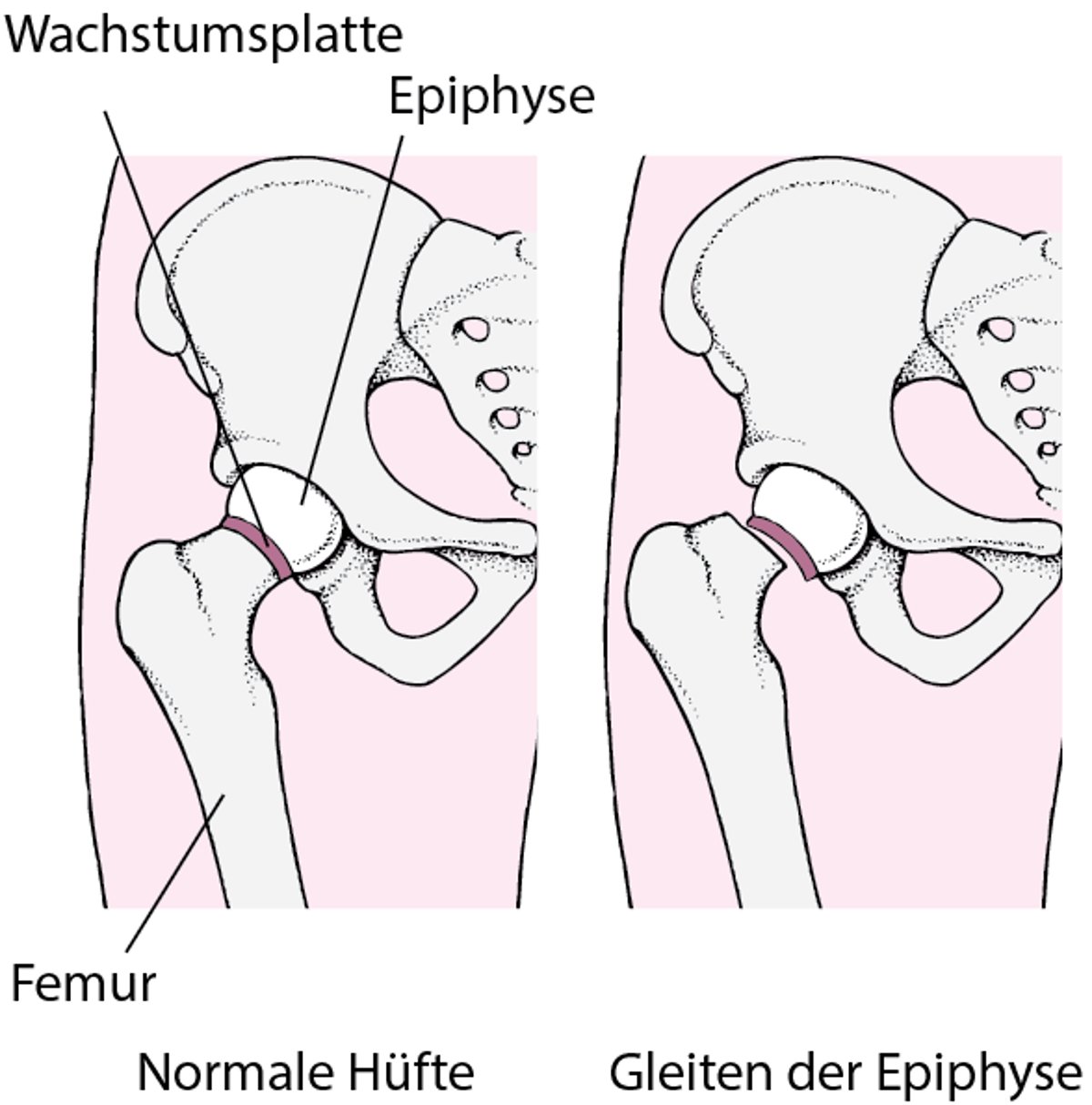 Juvenile Hüftkopflösung