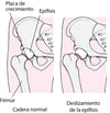 Epifisiólisis de la cabeza femoral