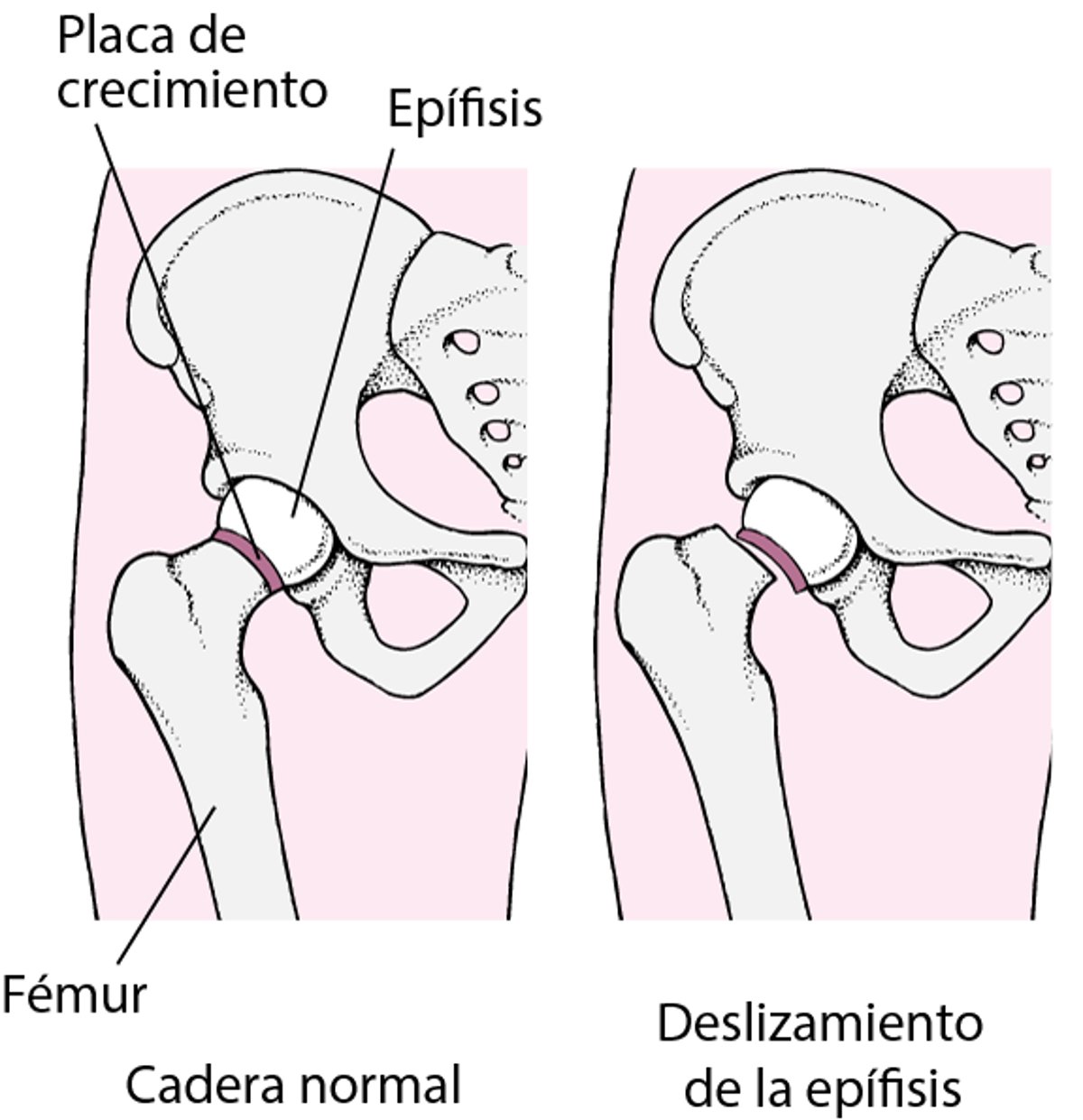 Epifisiólisis de la cabeza femoral