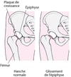 Épiphysiolyse fémorale supérieure