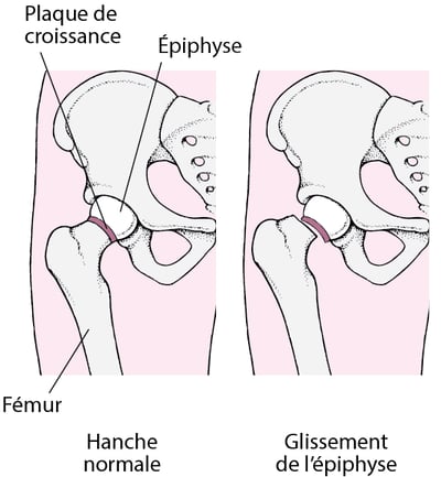 Épiphysiolyse fémorale supérieure