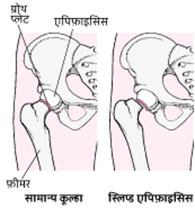 स्लिप्ड कैपिटल फ़ेमोरल एपिफ़ाइसिस