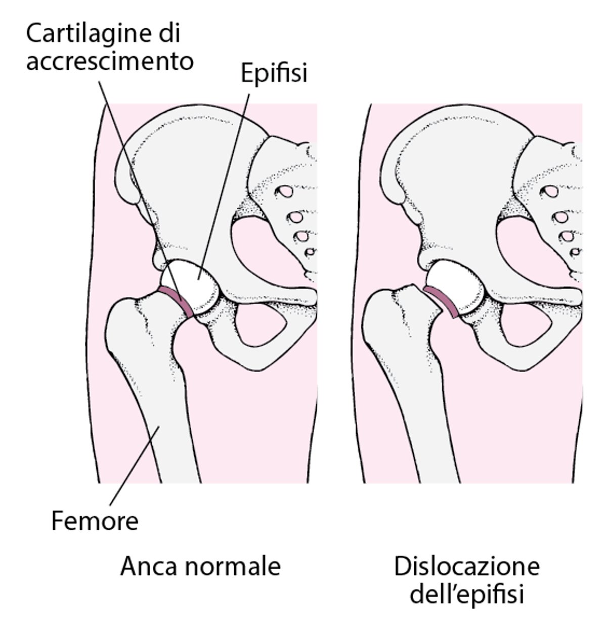 Epifisiolisi della testa femorale