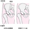 大腿骨頭すべり症