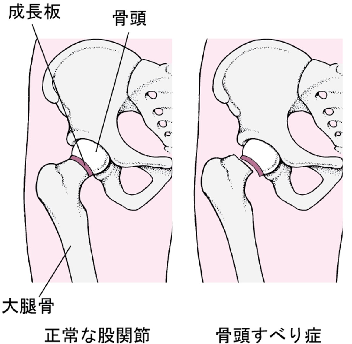 大腿骨頭すべり症