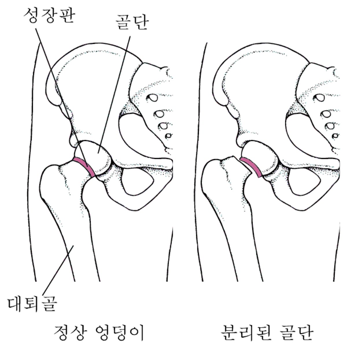 대퇴골두 골단 분리증