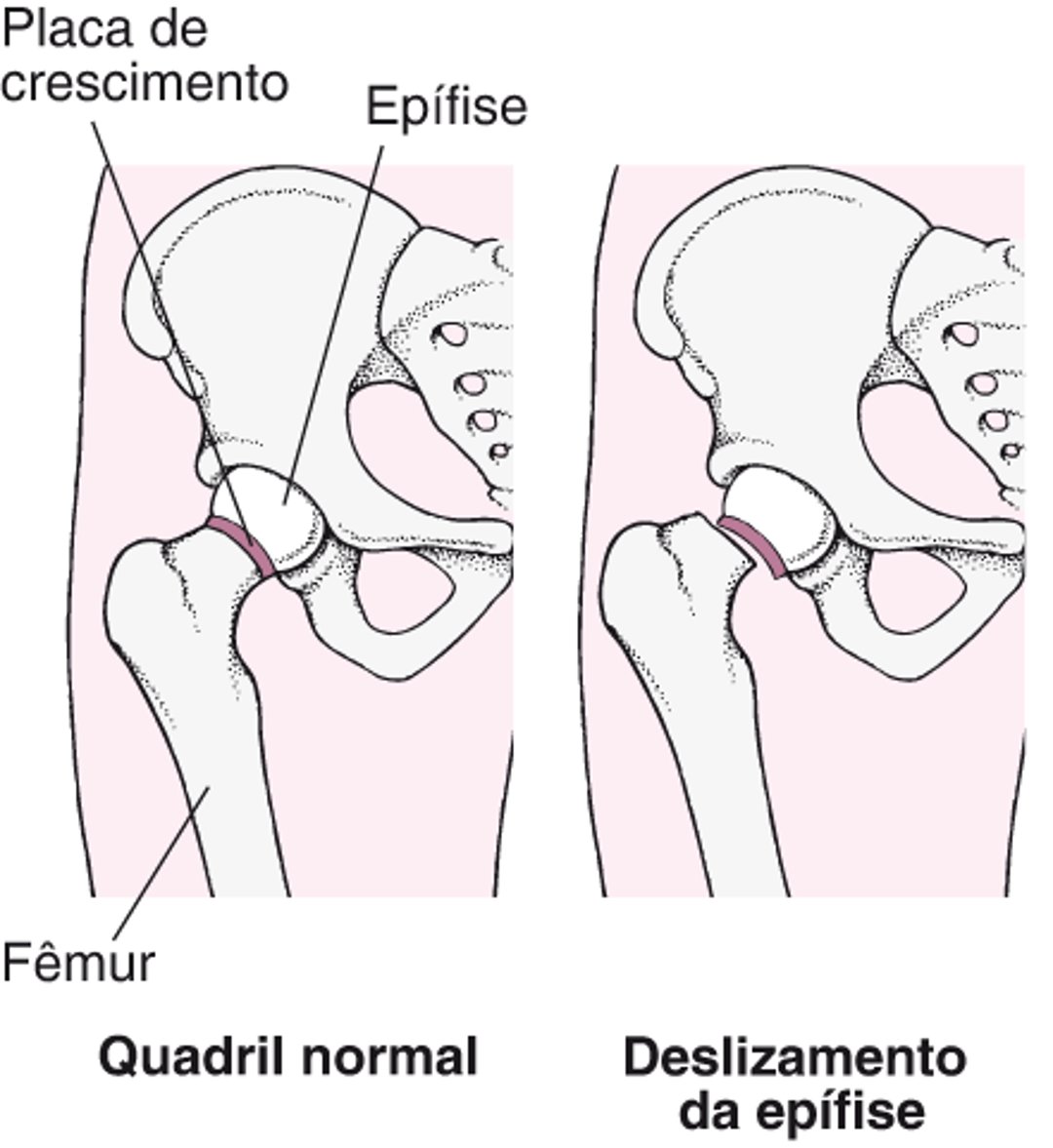 Desvio epifisário da cabeça do fêmur