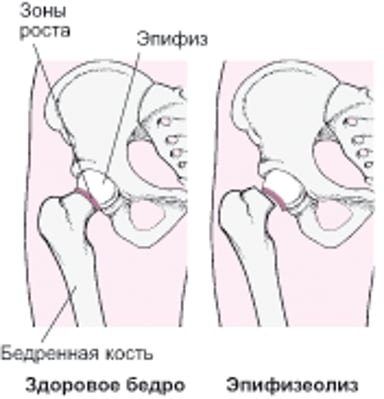 Эпифизеолиз головки бедра