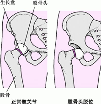 股骨头骨骺滑脱