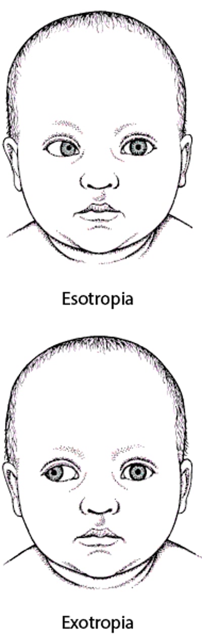 Strabismus: A Misaligned Eye