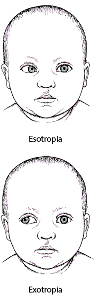 Как выглядит косоглазие у детей до года Strabismus - Children's Health Issues - MSD Manual Consumer Version