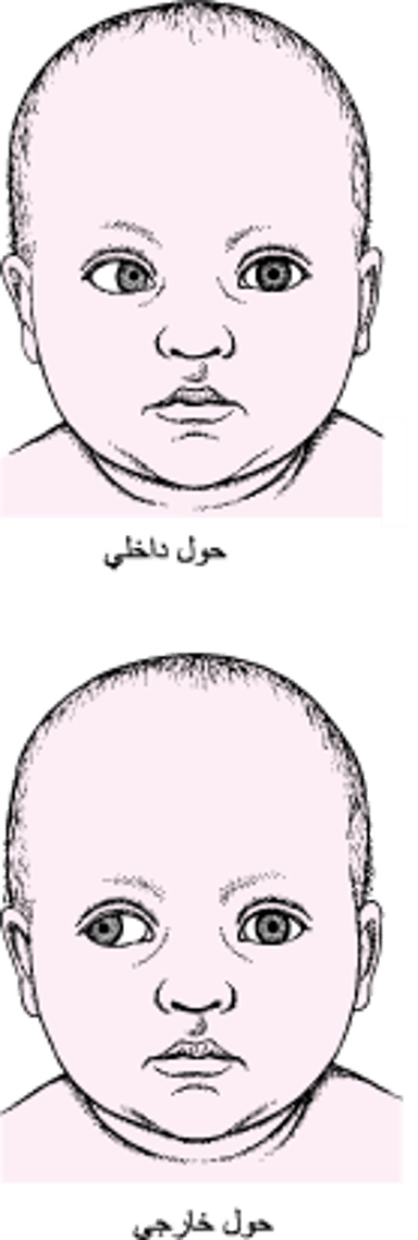 الحول: سوءُ تراصف العين