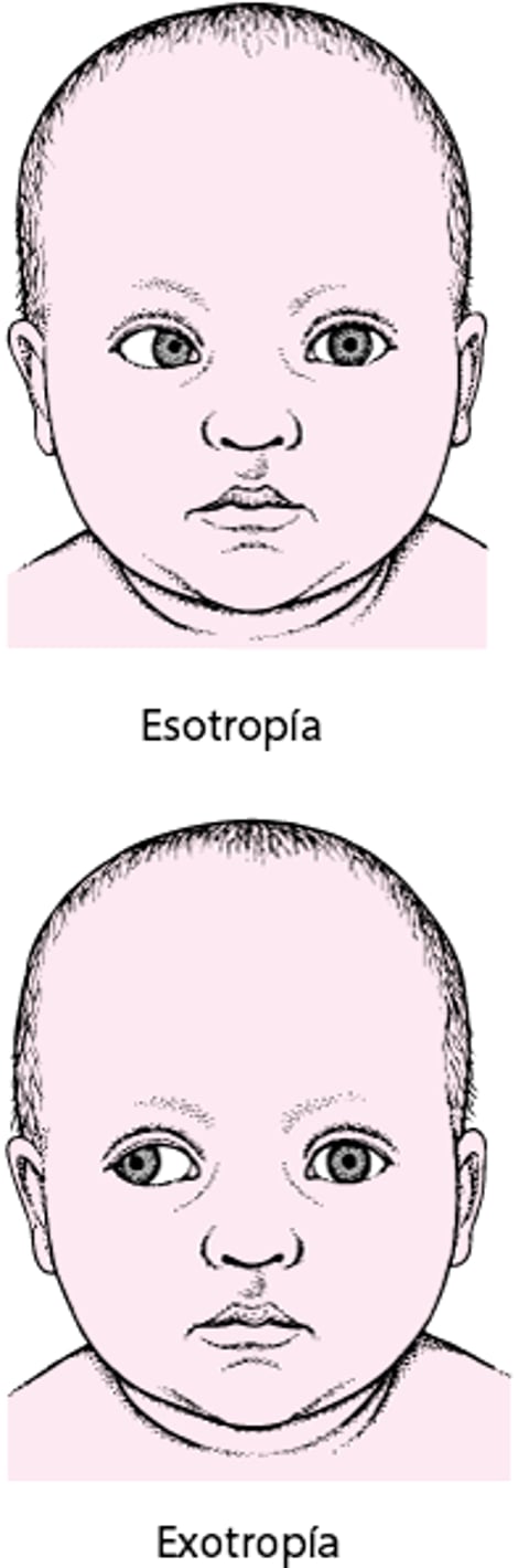 Estrabismo: un ojo desviado