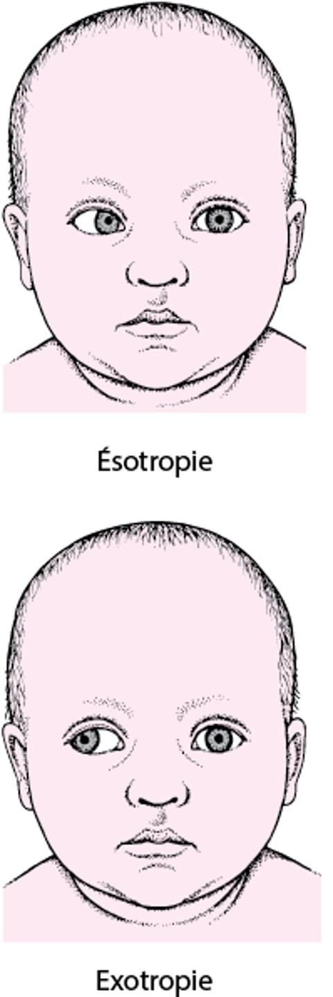 Strabisme : Déviation de l’axe oculaire