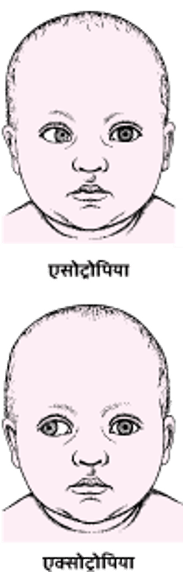 भेंगापन: एक गलत संरेखित आँख