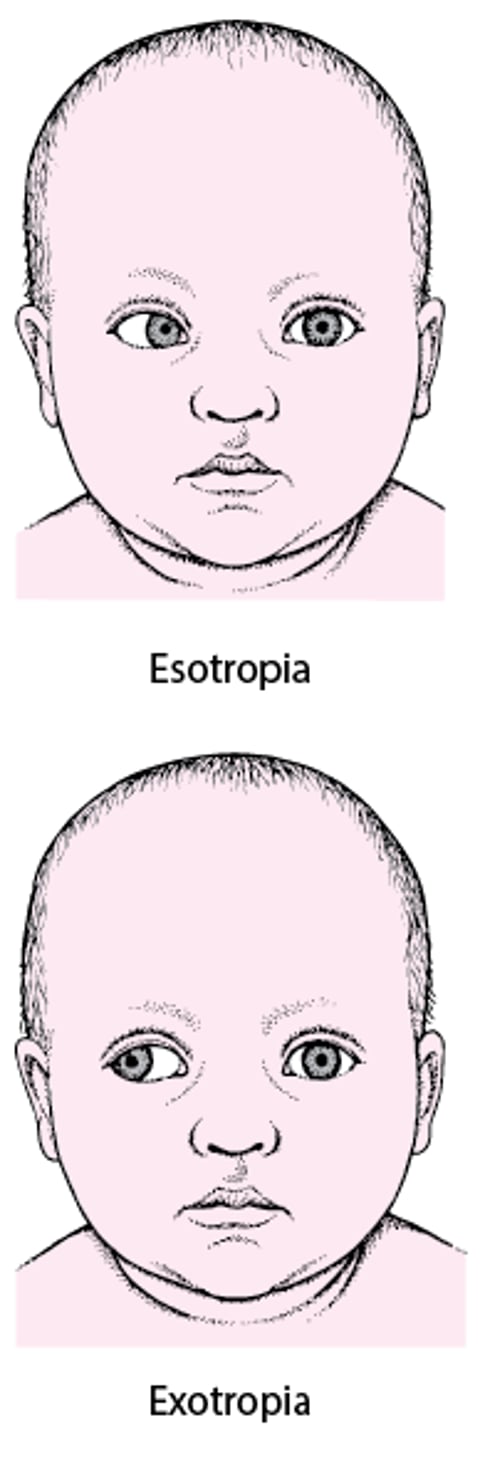 Strabismo: Disallineamento di un occhio