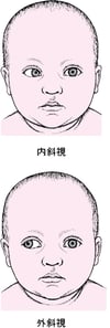 斜視：左右の眼の向きがずれた状態