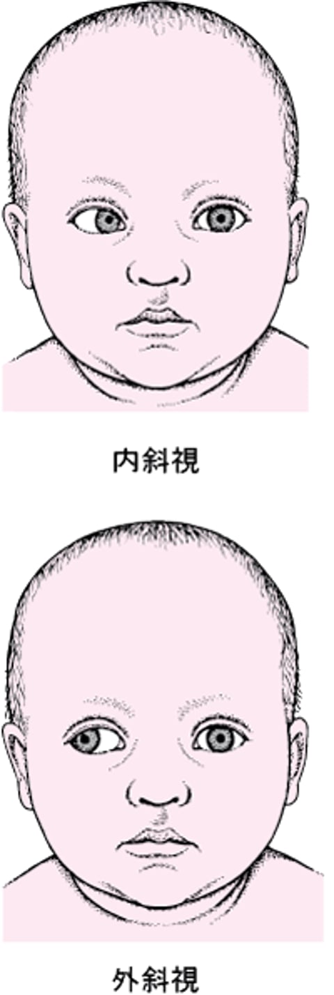 斜視：左右の眼の向きがずれた状態