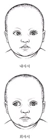 사시: 오정렬된 눈